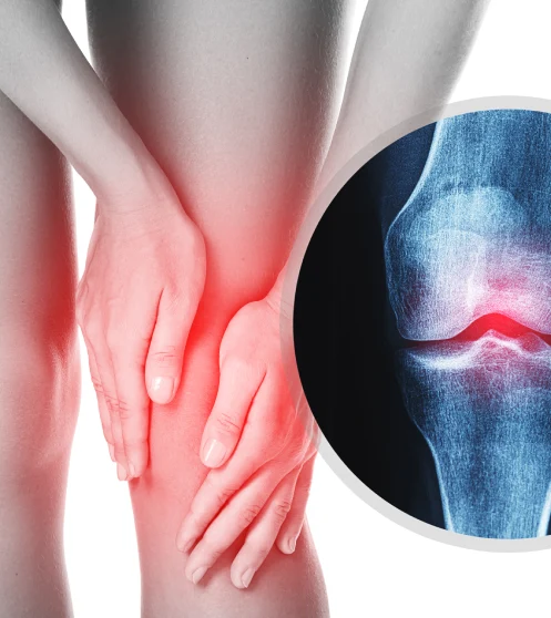 protesis-de-rodilla-costo-en-queretaro.webp